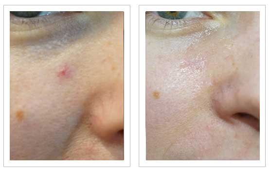 Thread Vein Removal Before and after1